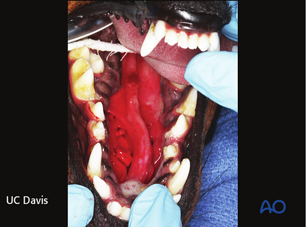 Palatal obturator can be used as salvage procedure to cover the defect