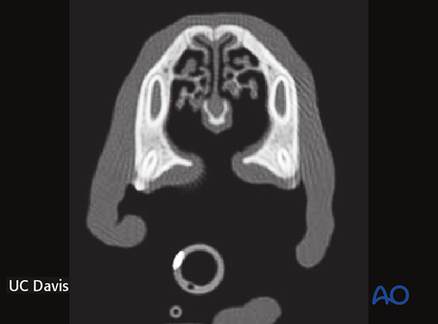 Cleft hard and soft palate