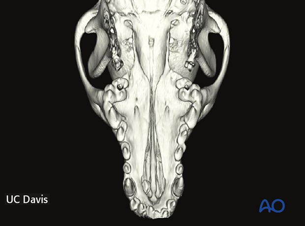P160 Staged double layer closure