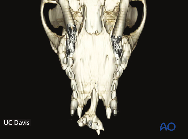Cleft lip and palate
