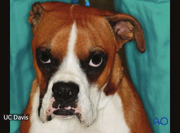 Cleft hard and soft palate