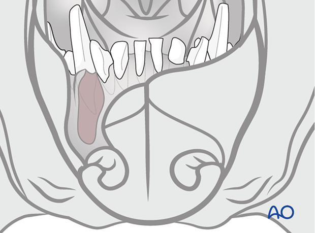 Cleft lip (CL) and dentoalveolar cleft