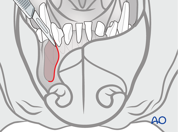 a pedicle flap is created from the medial nasal wall