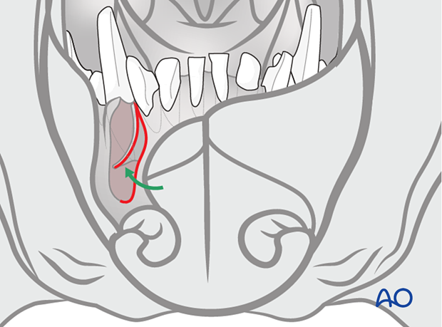 The mobilized flap is reflected laterally