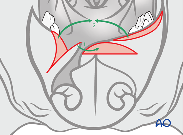 The first flap is created from the lateral side of the cleft