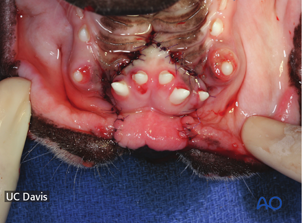 The laterally rotated flap is sutured