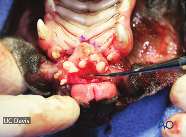Surgical planning and removal of the incisive bones