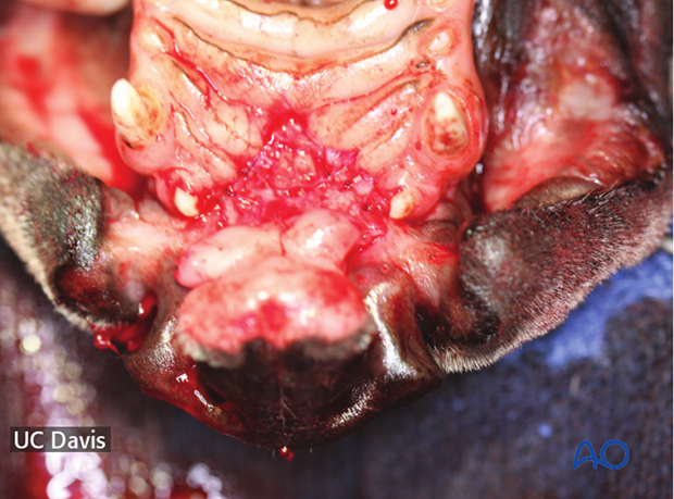 Establishment of the nasal floor after removal of the incisive bone