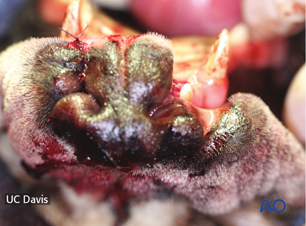 Repair of the cleft lip on the left side