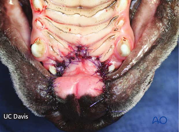 Complete repair of the bilateral cleft lip and dentoalveolar cleft