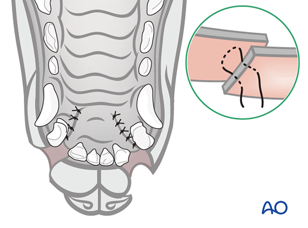 Repair of the cleft of the primary palate