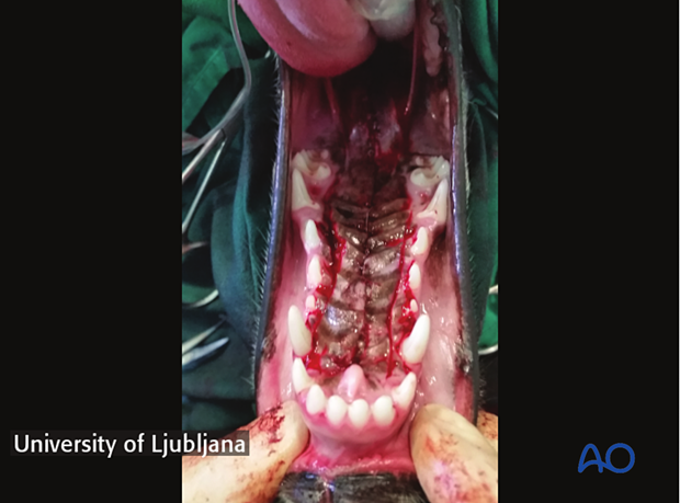 P120 von Langenbeck technique