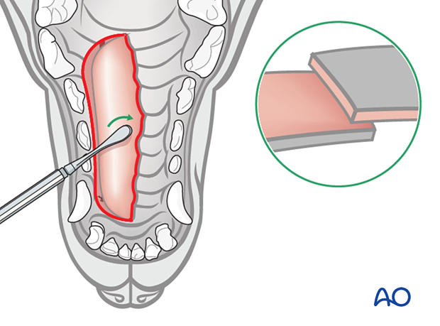 The reflected mucoperiosteal flap is hinged over the defect