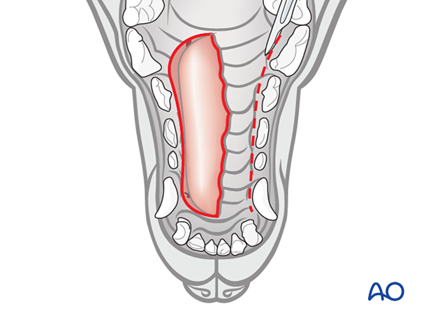 a releasing incision (dotted line) 2-3 mm palatal to the maxillary teeth is required to close the wound