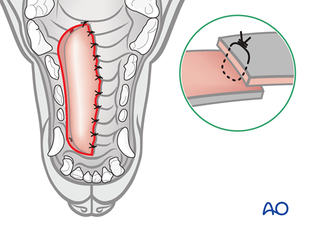 The hinged flap is sutured