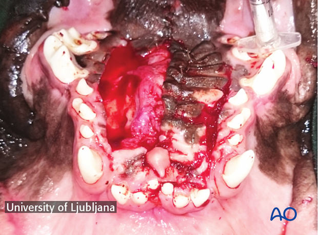 Completed repair of the cleft palate