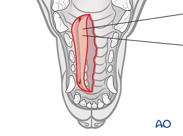 stay sutures to manipulate the flap