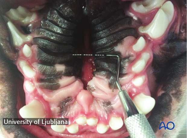 Midline cleft of the hard palate