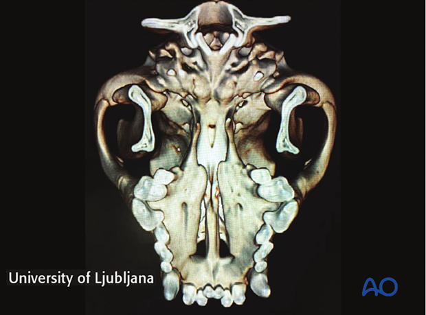 large bony defect in the area of palatine fissures