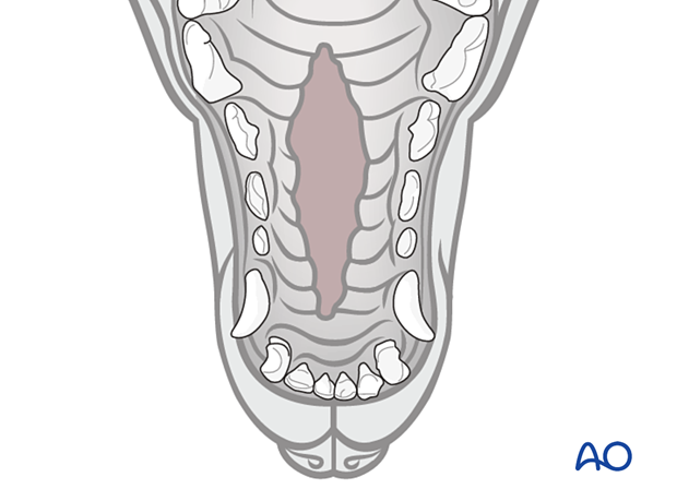 Hard palate defect
