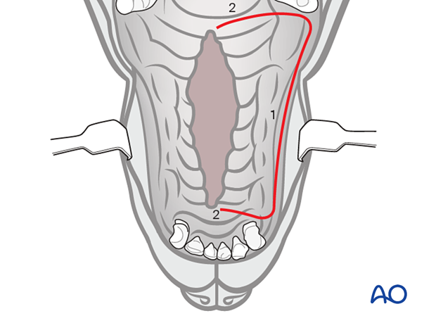 Creation of mucoperiosteal flap