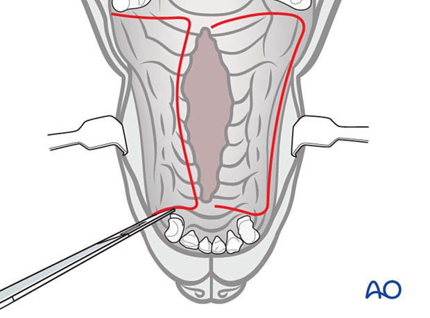 Creation of reflected flap
