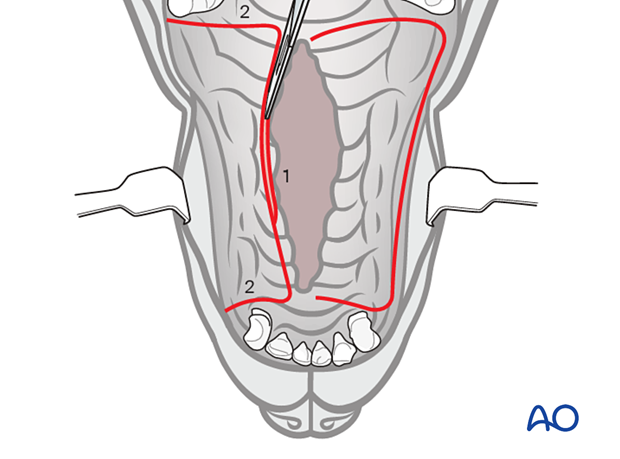 The edge of the palatal mucosa at the defect edge is tangentially incised