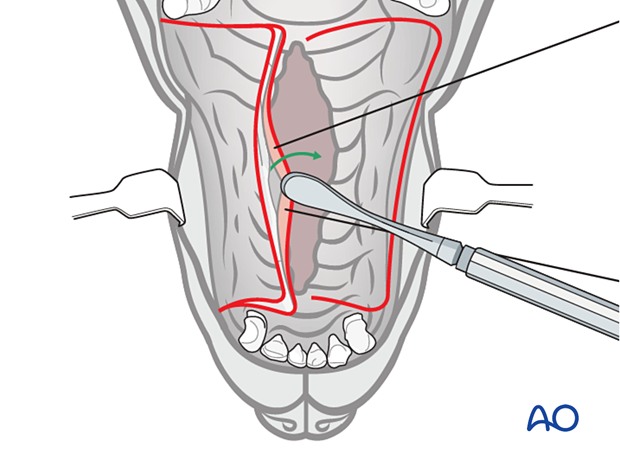 create the single pedicle advancement flap