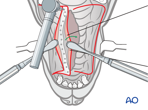 Holes are created on the exposed palatine process of the maxillary bone