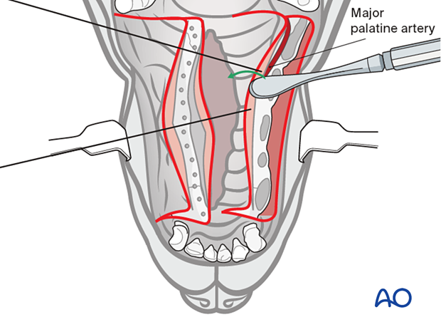 The reflected flap is raised using a periosteal elevator