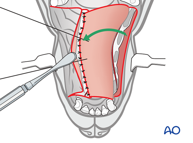The reflected flap is reversed and secured to the holes with preplaced sutures