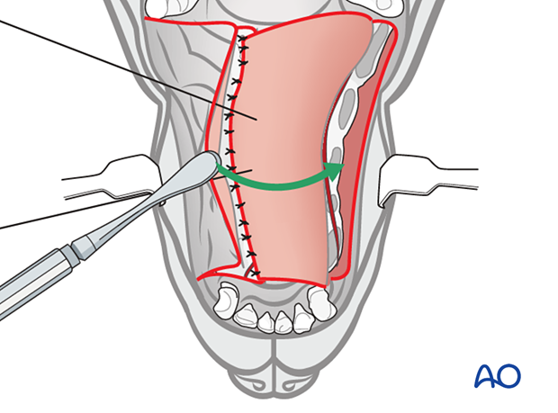 The single pedicle advancement flap, if large enough, is sutured