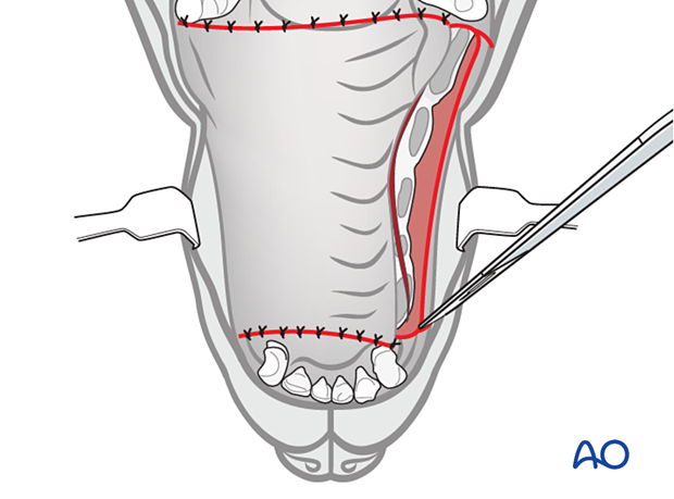A third flap is used in case the first flap was not sufficient to cover the denuded area of the palatal bone