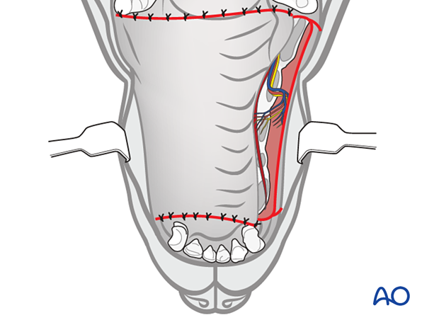 Care is taken to preserve the infraorbital neurovascular structures