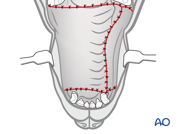 the flap is advanced and secured to the edge of the contralateral single pedicle advancement flap