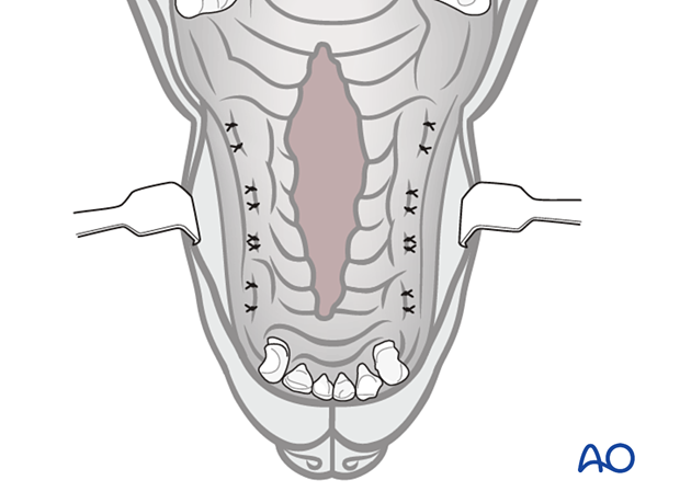 Selective dental extractions of maxillary teeth