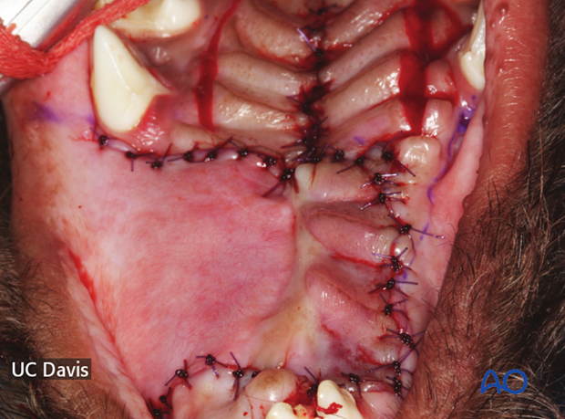 the rostral part of the hard palate defect was repaired with a double-layer technique