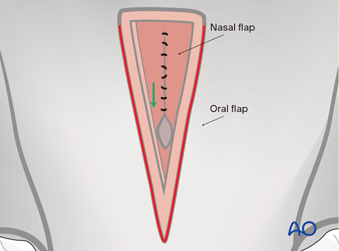 Appositional Pattern Double- or three-layer appositional technique for Cleft soft palate