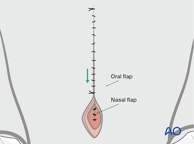 In larger dogs, apposition of the palatal muscles and connective tissue can be sutured