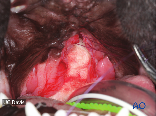 sutures are preplaced on the nasal flap