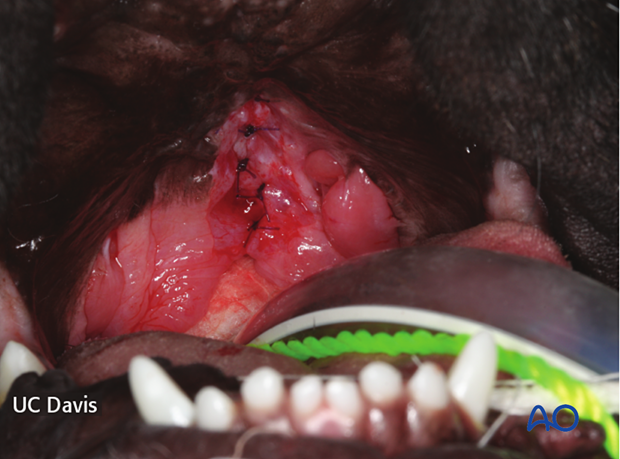 The nasal flap is sutured in a single interrupted pattern