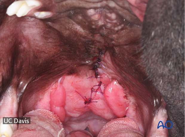 Final result of the midline soft palate defect repaired using the double-layer apposition technique