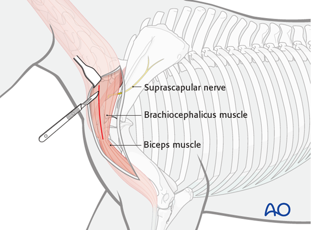 shoulder arthrodesis