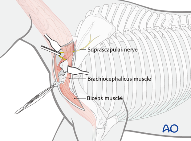 shoulder arthrodesis