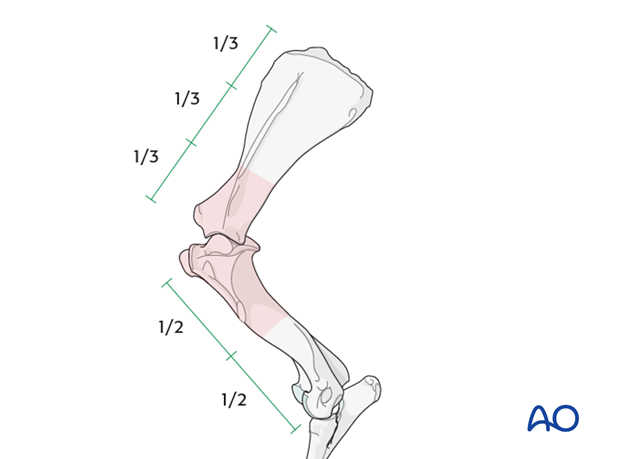 shoulder arthrodesis