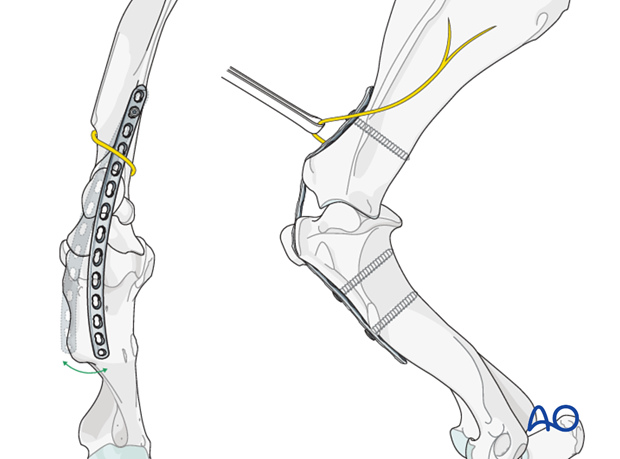 shoulder arthrodesis