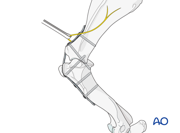 shoulder arthrodesis