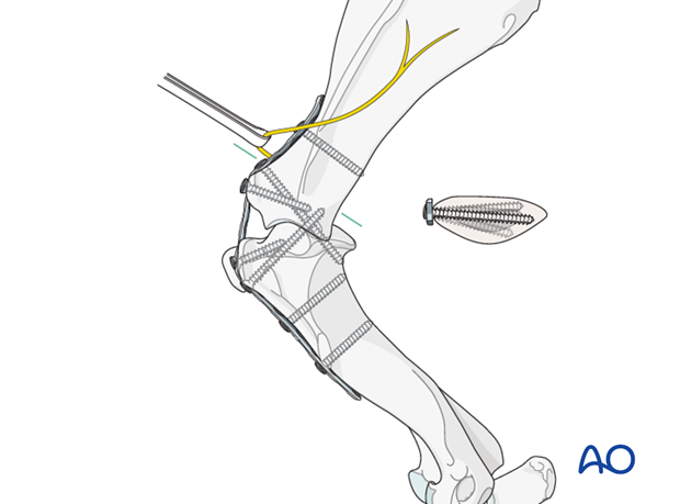 shoulder arthrodesis