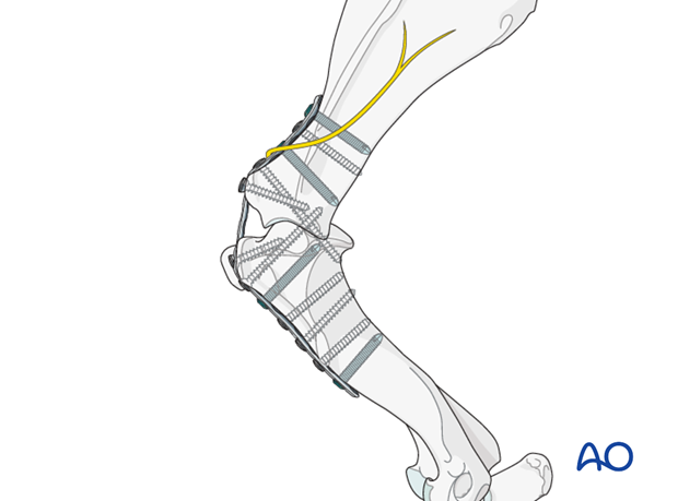 scapulohumeral joint degenerative joint disease