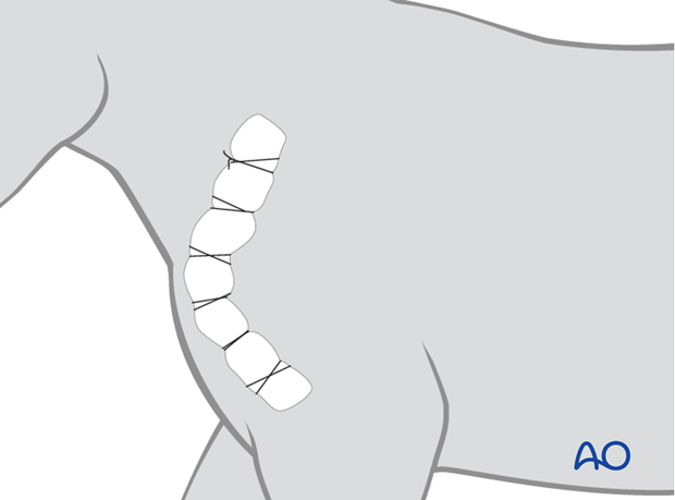 shoulder arthrodesis